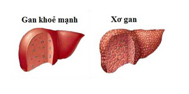 Chế độ ăn kìm hãm sự tiến triển của xơ gan - 1