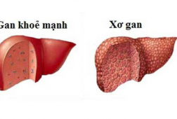 Giai đoạn nguy hiểm nhất của bệnh xơ gan bạn cần biết