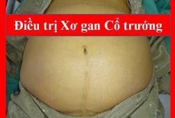 Phương Pháp Hiệu Quả Cho Bệnh Xơ Gan Cổ Trướng ” Giai Đoạn Cuối”